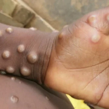 28 cas confirmés dont un mort en Côte d’Ivoire – Ce qu’il faut savoir sur la «variole du singe» ou Mpox