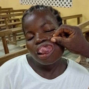 Bianouan – S.O.S pour la jeune Amandine Bationo souffrant de malformation !