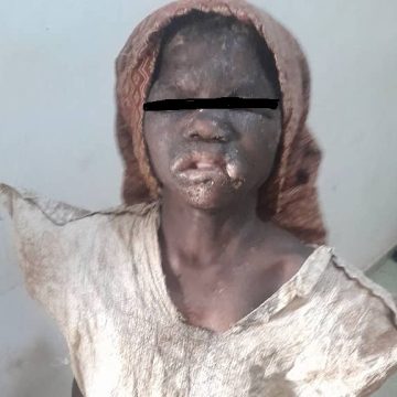 Bouaké – Une fillette torturée par sa grand-mère, la police l’arrache de l’enfer