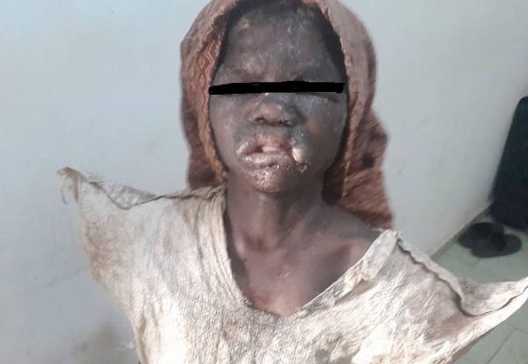 Bouaké – Une fillette torturée par sa grand-mère, la police l’arrache de l’enfer